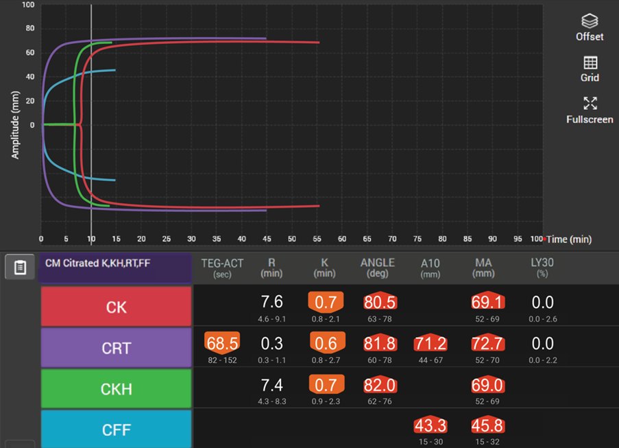 A. TEG® 6s tracing in a COVID-19 patient with concurrent bleeding and thrombosis. 