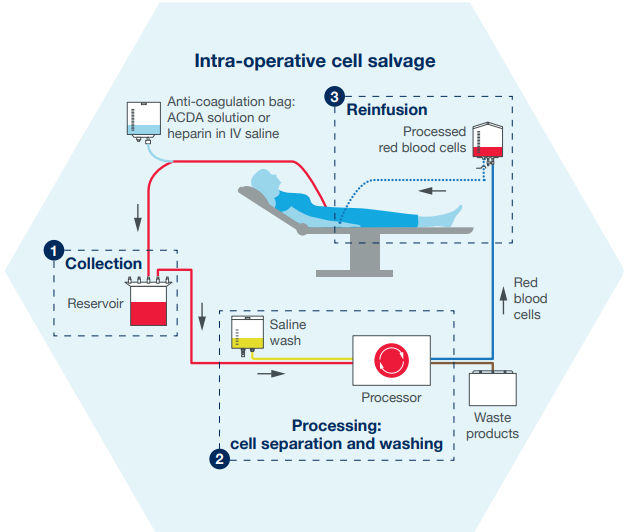 Intra-operative cell salvage