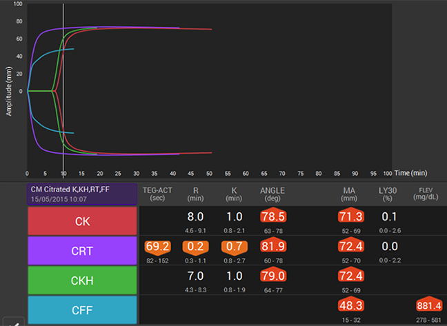 A. Hypercoagulable trace during the third trimester